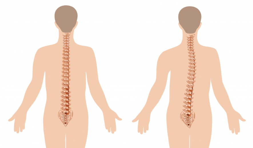 prejav osteochondrózy